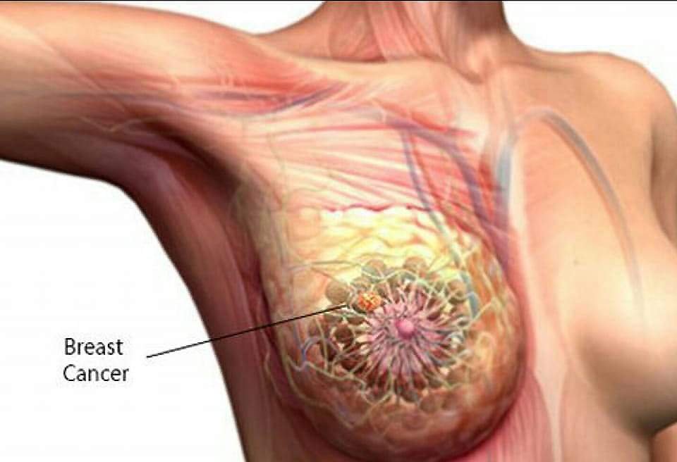 Breast Cancer Specialist in Ranchi